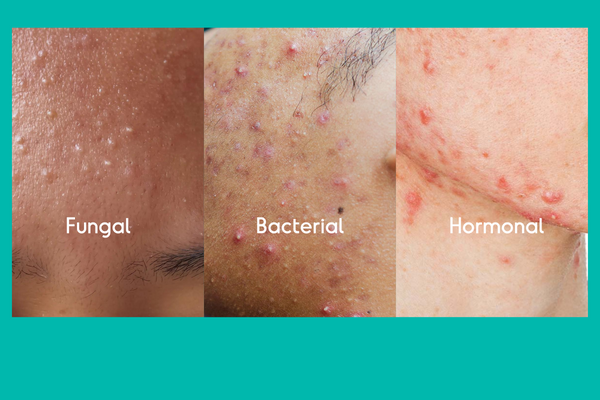 Fungal vs. Bacterial vs. Hormonal Acne: What’s The Difference?