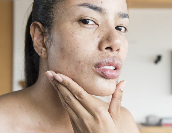 does acne prone skin need moisturizer?