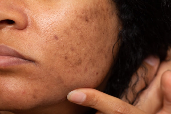 What Causes Hyperpigmentation and How to Get Rid of It