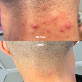 Folliculitis Treatment - Almond Clear - 1 oz