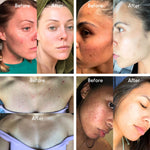 Fungal Acne Treatment - Level 1 Mandelic Acid Serum