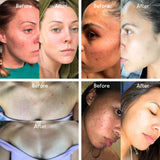 Fungal Acne Treatment - Level 1 Mandelic Acid Serum