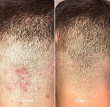 Folliculitis Treatment - Almond Clear - 1 oz
