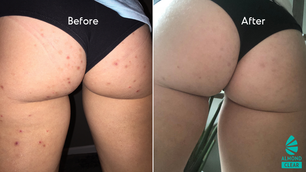 Red Bumps on the Butt: Causes & Treatment