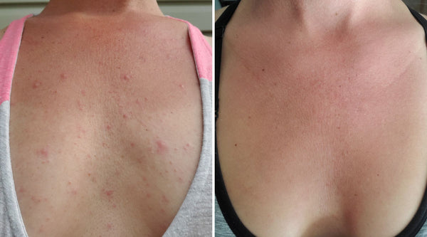 fungal acne before and after