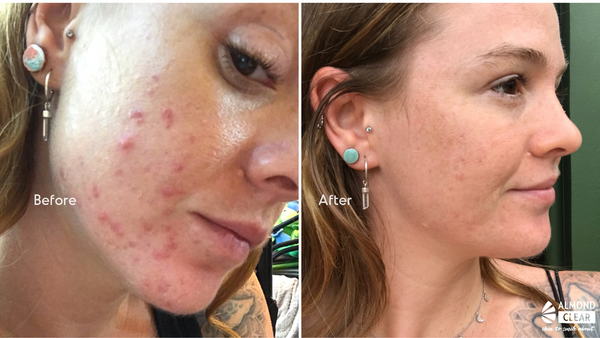 mandelic acid before and after