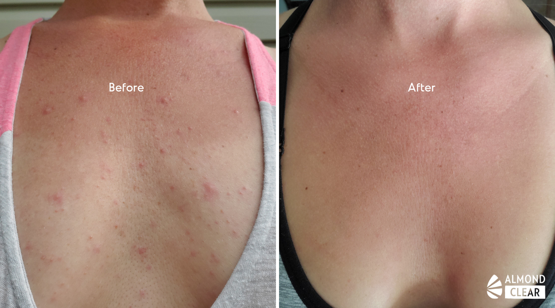 fungal acne before and after