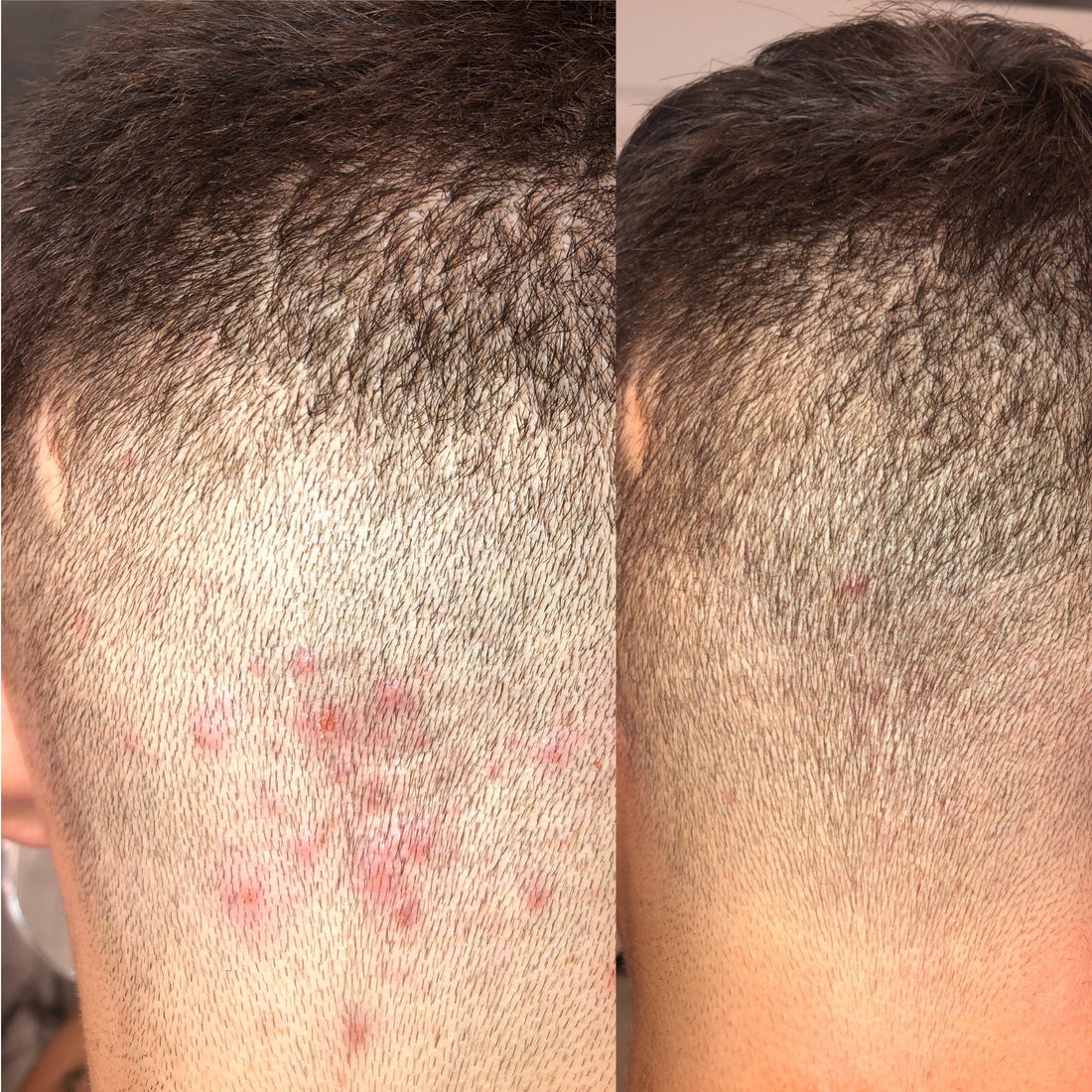 folliculitis treatment before and after