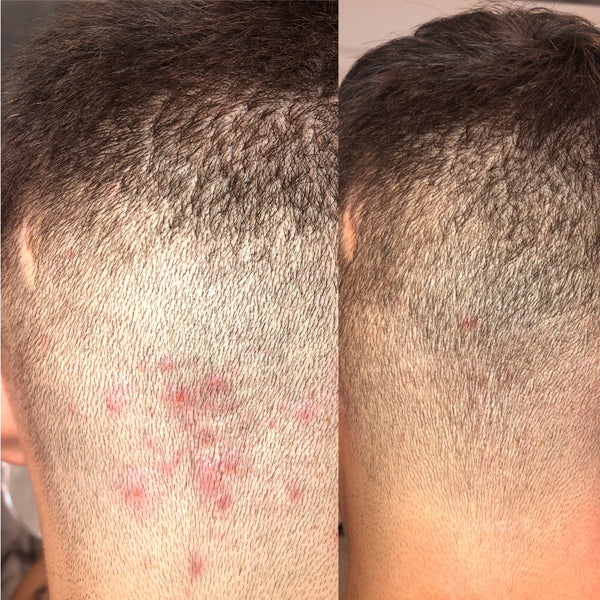 folliculitis treatment before and after