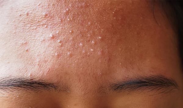 What Does Fungal Acne Look Like and How to Treat It