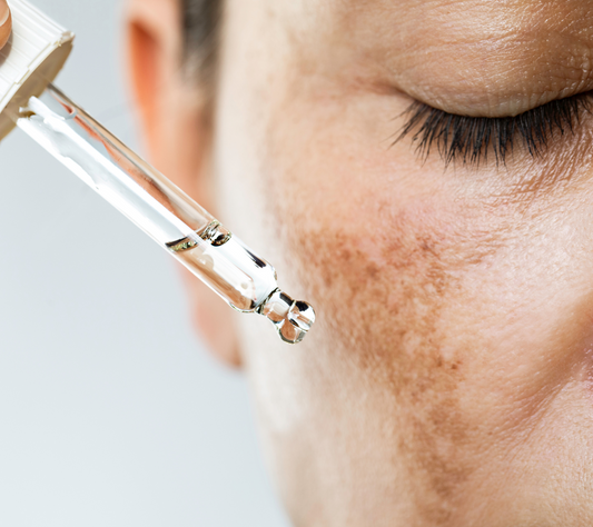 Why Mandelic Acid is a Great Solution to Hyperpigmentation-prone Skin