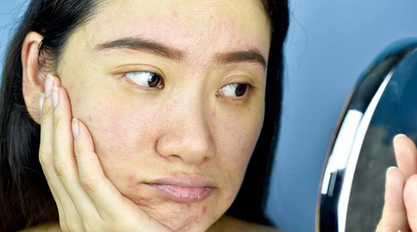 Dull skin: what causes it and how to treat it 