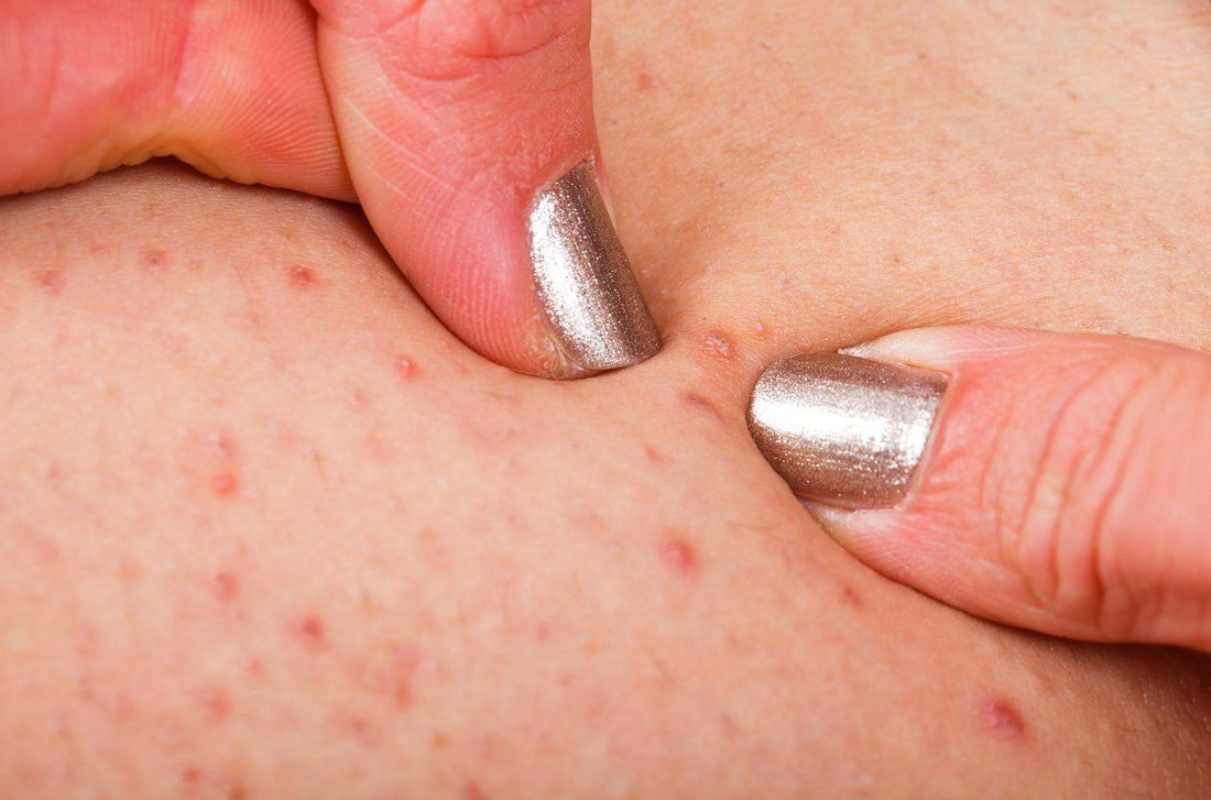 Folliculitis Causes, Treatments, and Tips