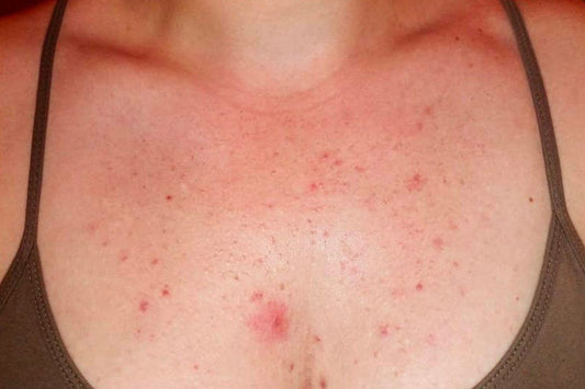 Fungal Acne Symptoms