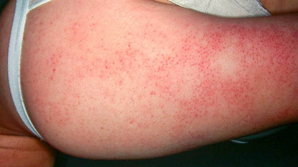 how do you get rid of keratosis pilaris naturally?