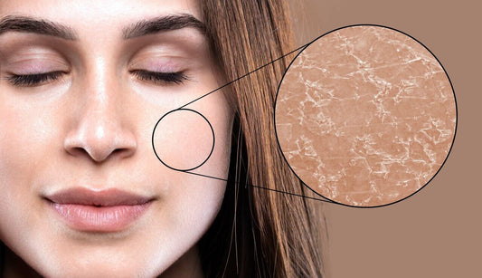 Do I Have Dry or Dehydrated Skin?