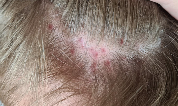 Scalp Folliculitis Treatment