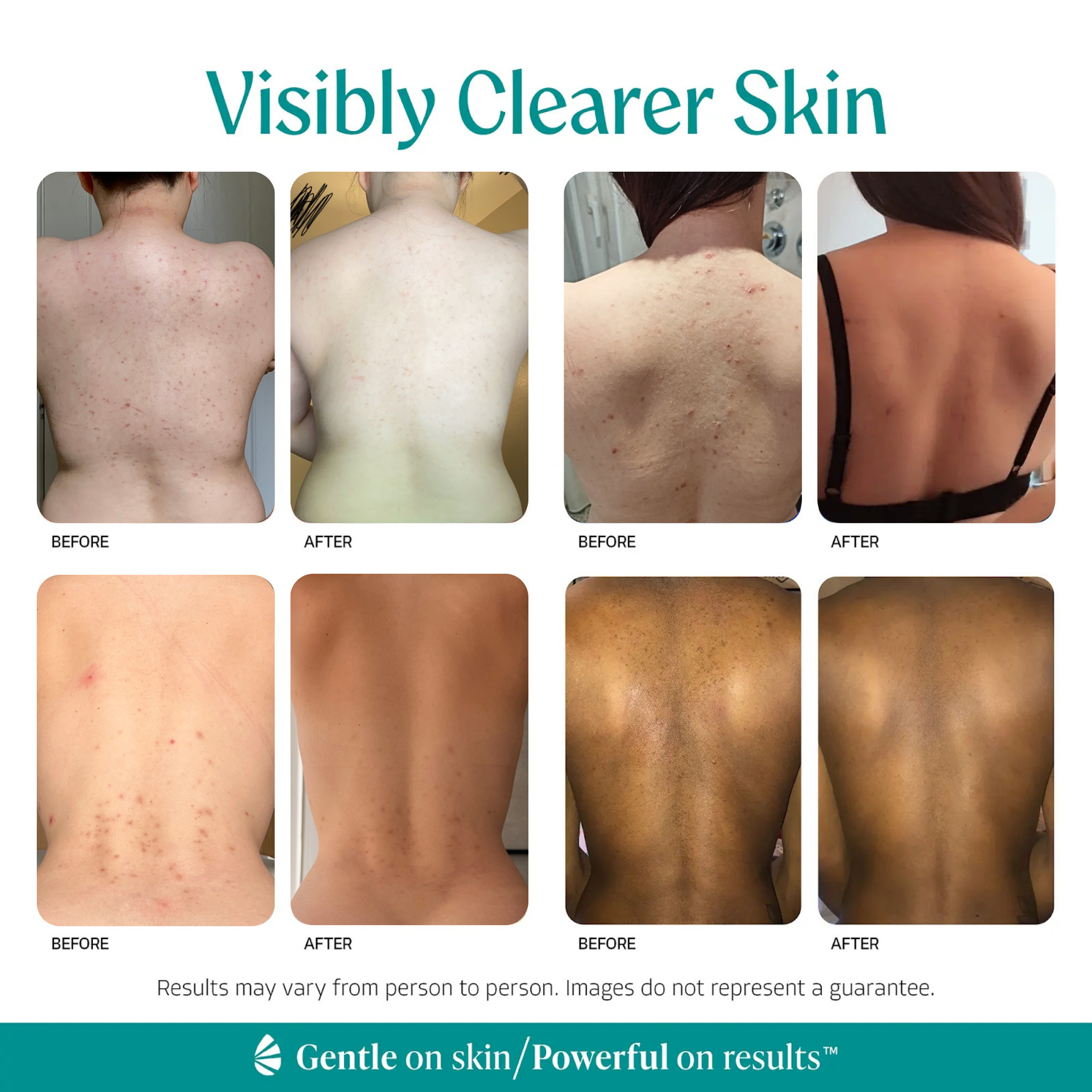 Back Acne Treatment - Level 2 Mandelic Acid Serum
