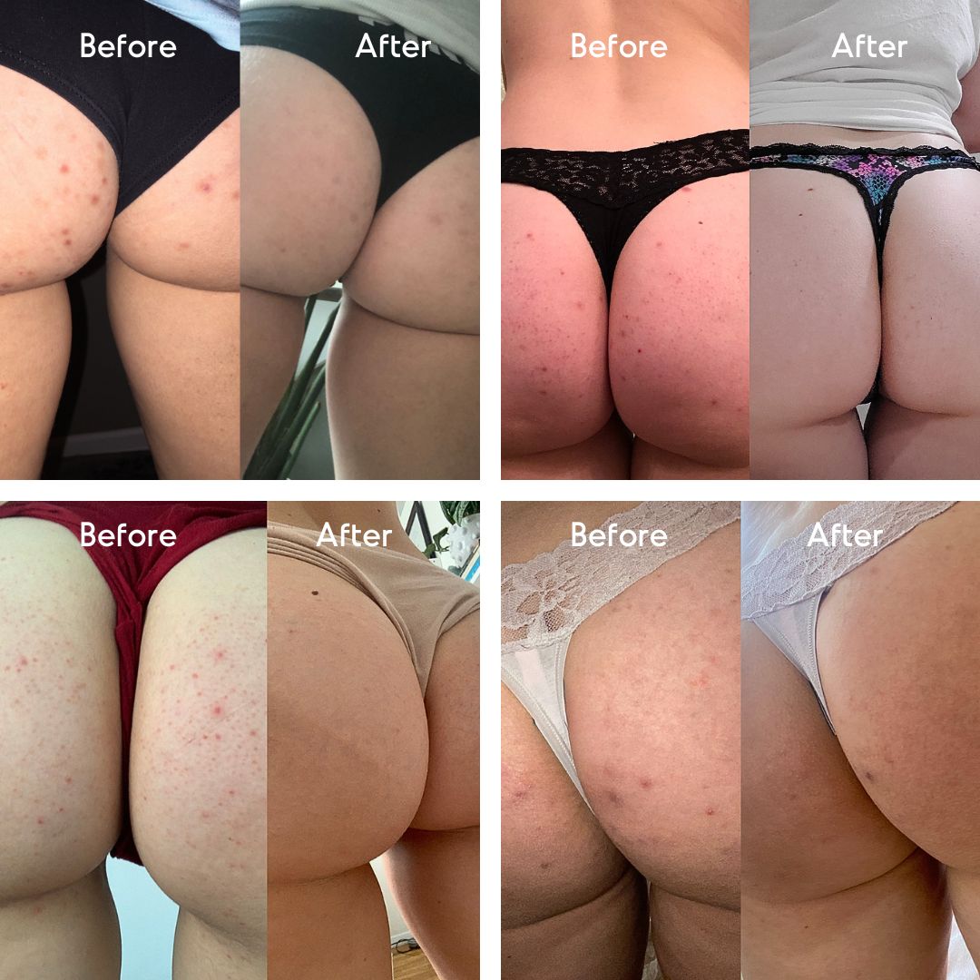 Butt Acne Treatment Serum - Level 2 Mandelic Acid Serum