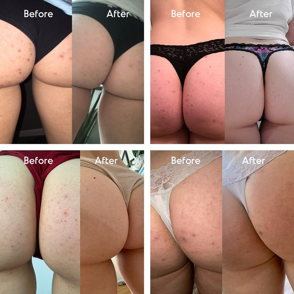 Butt Acne Treatment - Level 2 Mandelic Acid Serum