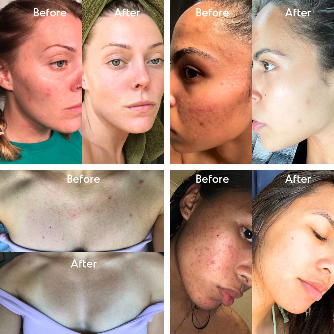 Before and after photos of Almond Clear results on facial acne, cheek breakouts, and redness