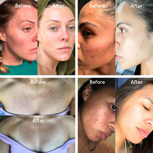 Before and after photos of Almond Clear results on facial acne, cheek breakouts, and redness