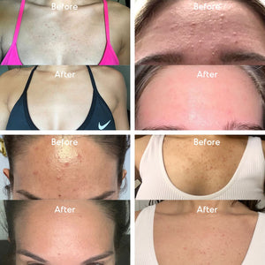Almond Clear before and after photos showing cleared forehead acne, face bumps, and chest breakouts