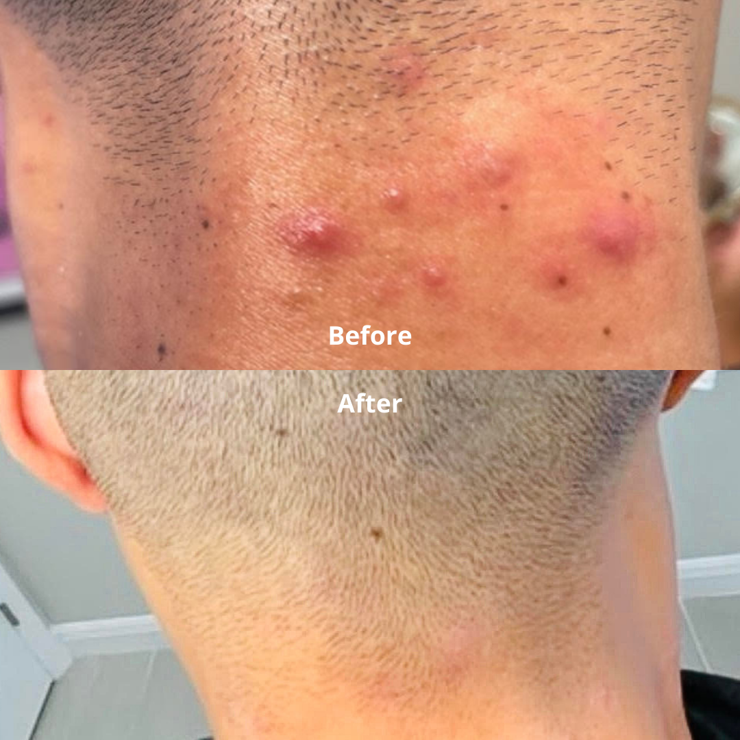 Before and after photos of Almond Clear results on inflamed bumps on the back of a man's neck and hairline