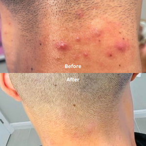 Before and after photos of Almond Clear results on inflamed bumps on the back of a man's neck and hairline