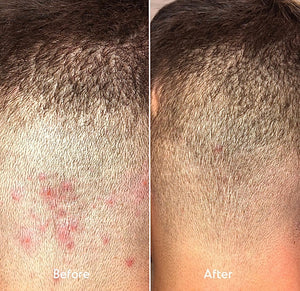 Before and after photos of Almond Clear clearing red bumps on the back of the neck and scalp hairline