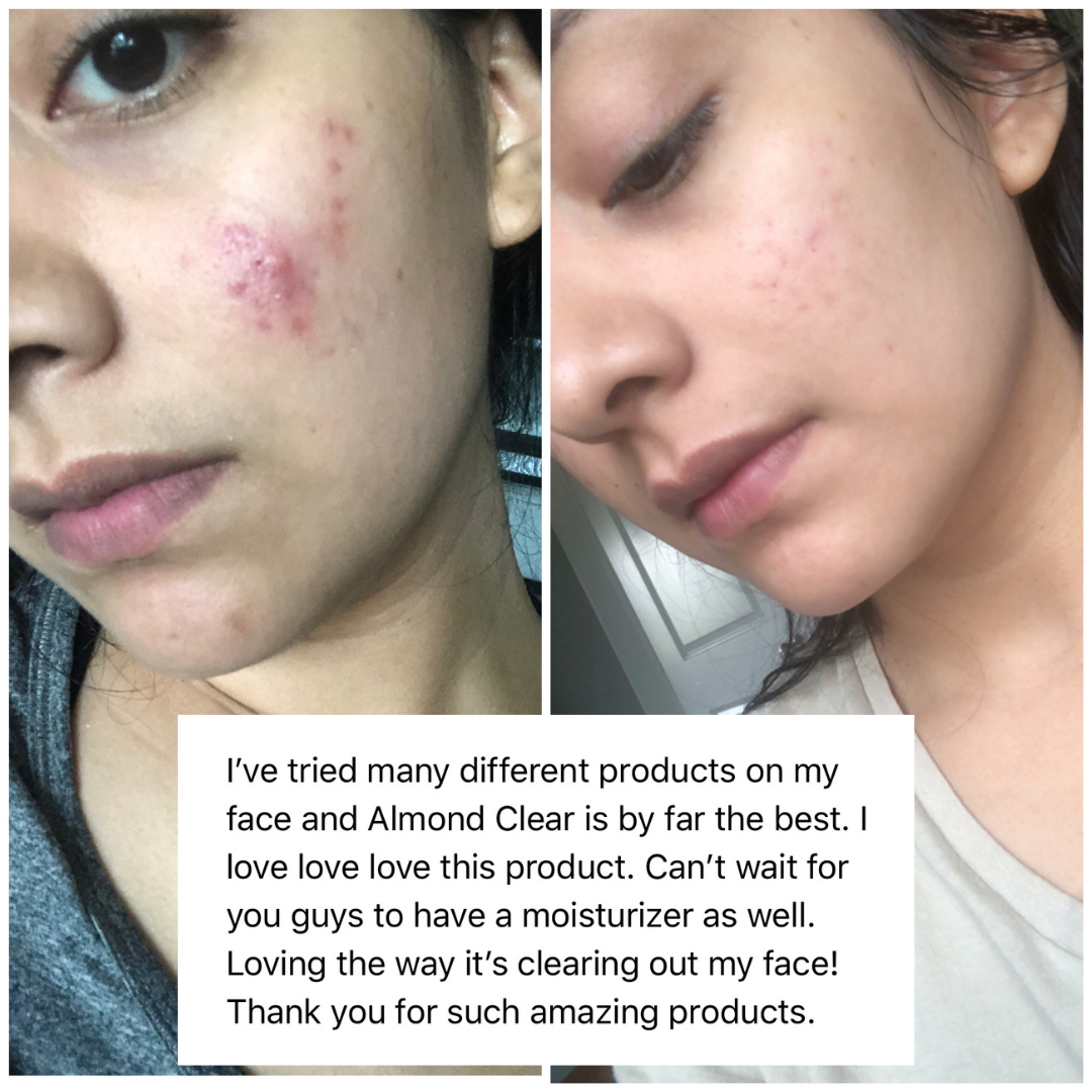 Customer review with before and after photos: Almond Clear is by far the best, loving the way it is clearing out my face