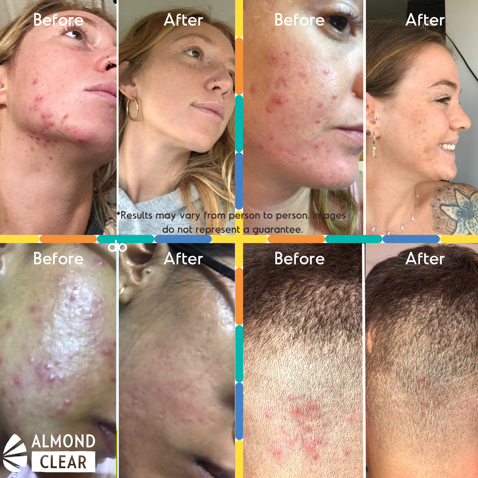 Before and after customer photos of face acne and scalp breakouts treated with Almond Clear; results may vary