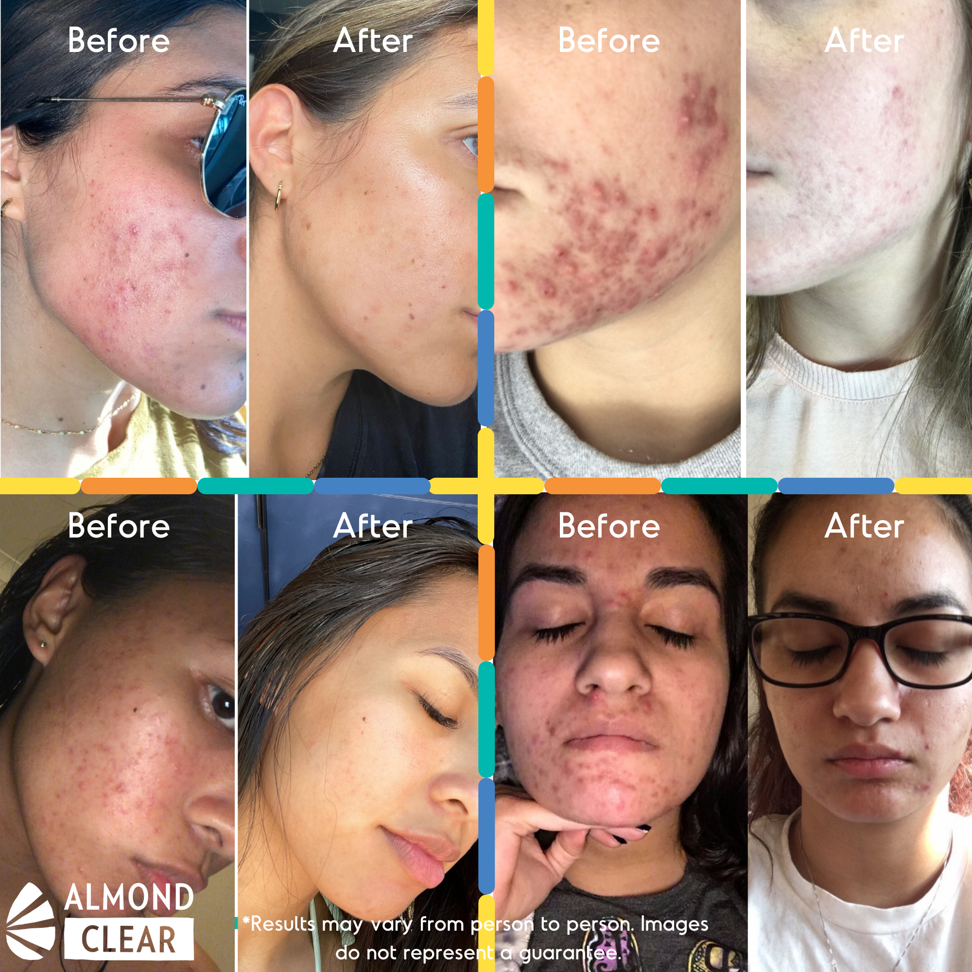 Facial acne and dark marks faded with Almond Clear, before and after photos of four customers; results may vary