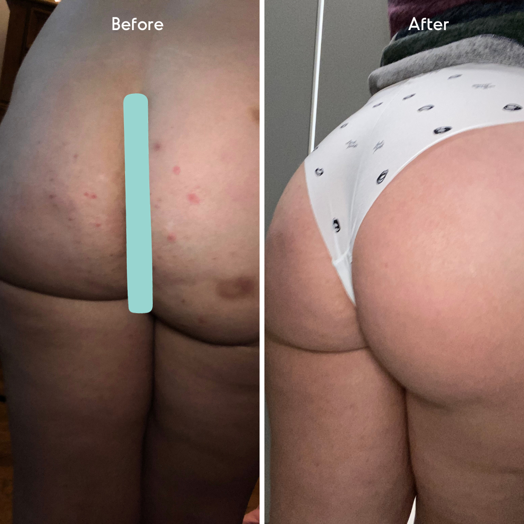 Butt Acne Treatment Serum - Level 2 Mandelic Acid Serum