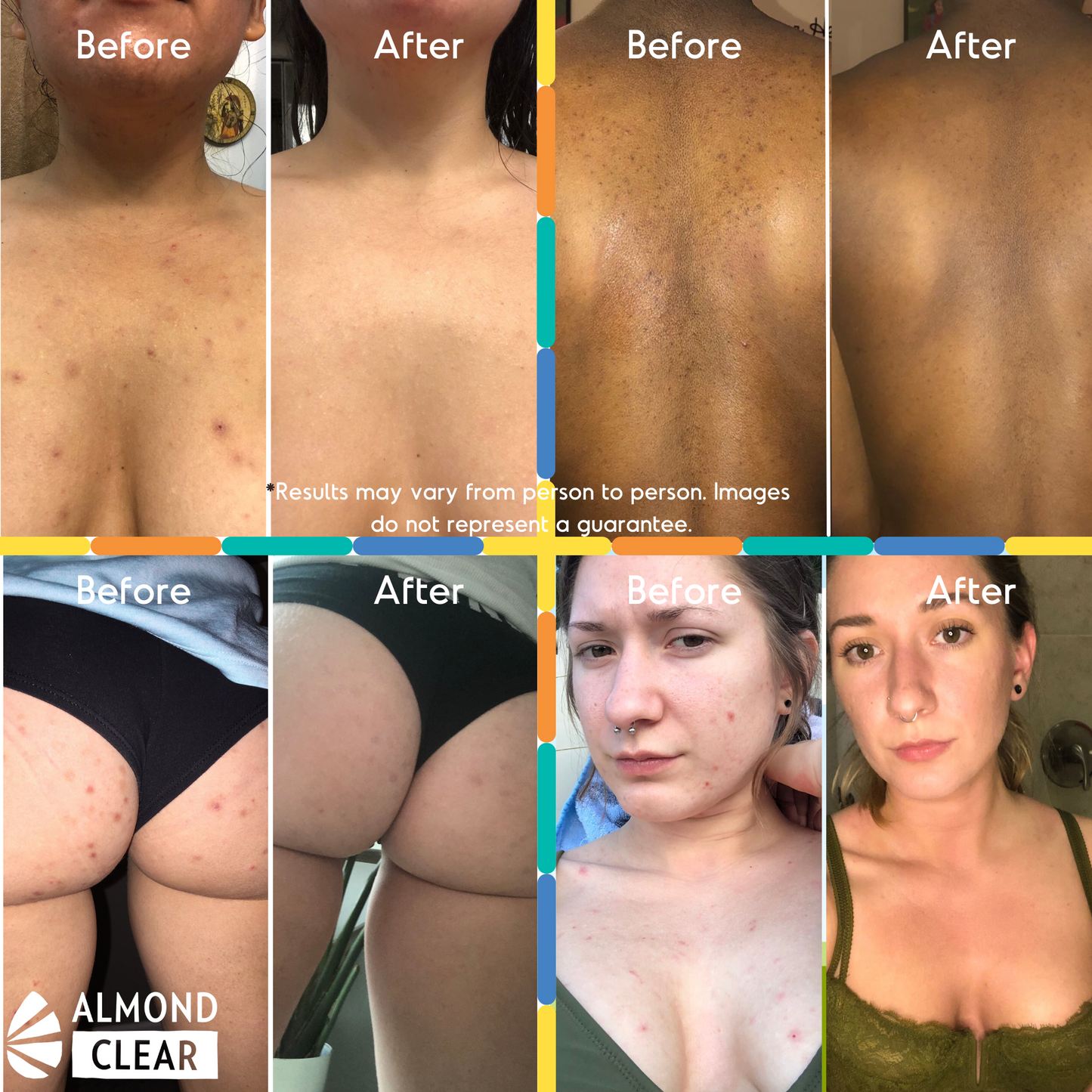 Body Folliculitis Treatment - Level 2 Mandelic Acid Serum