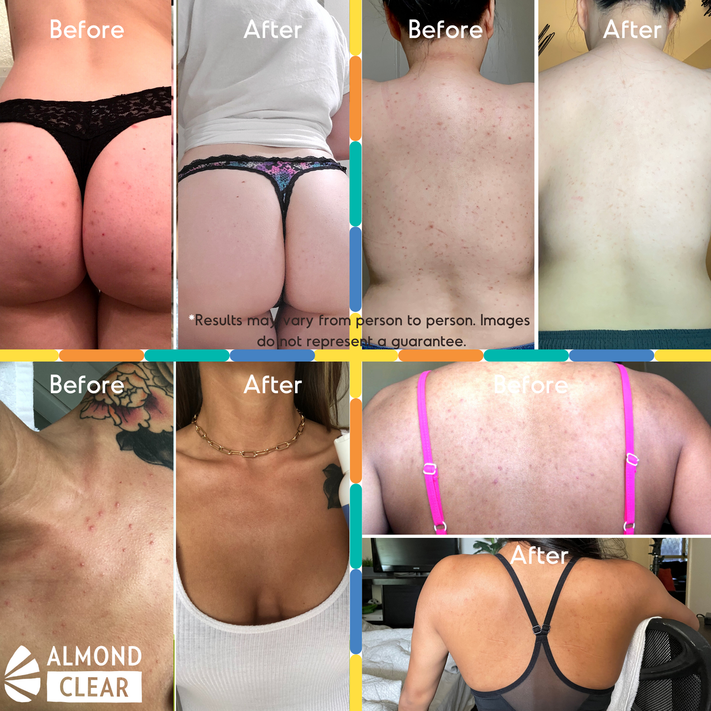 Body Folliculitis Treatment - Level 2 Mandelic Acid Serum